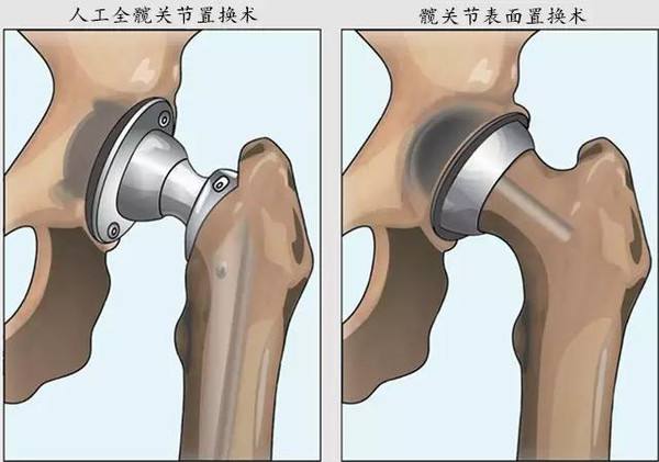 髖關節(jié)手術3.jpg